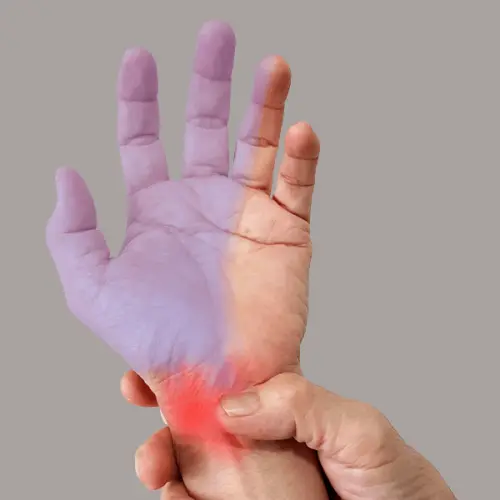 carpal tunnel syndrome update