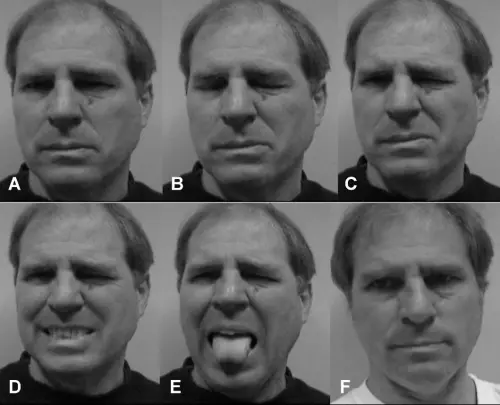 Hemifacial Spasm: Solusi Kedutan Wajah Sebelah ʕ•́ᴥ•̀ʔっ hemifacial spasm kedutan