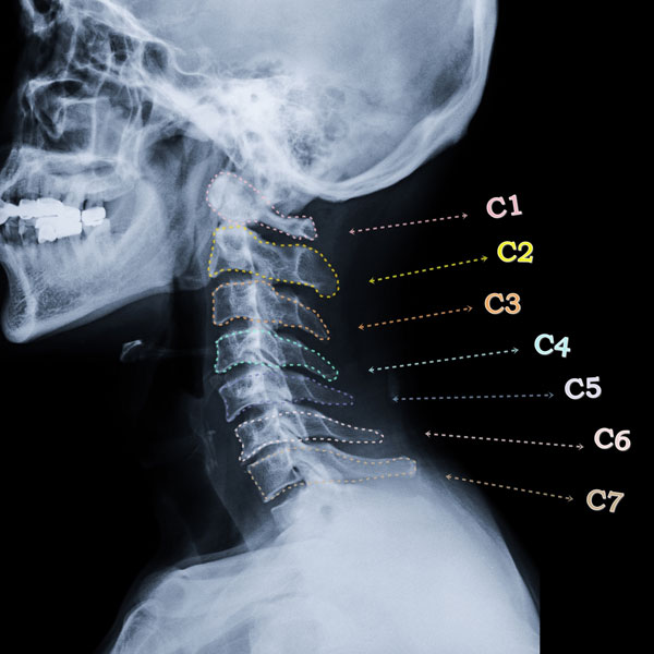 Ketika Leher "Menjepit" Saraf: DCM, Pencuri Keseimbangan yang Sering Tapi Jarang🤦 cervical spine
